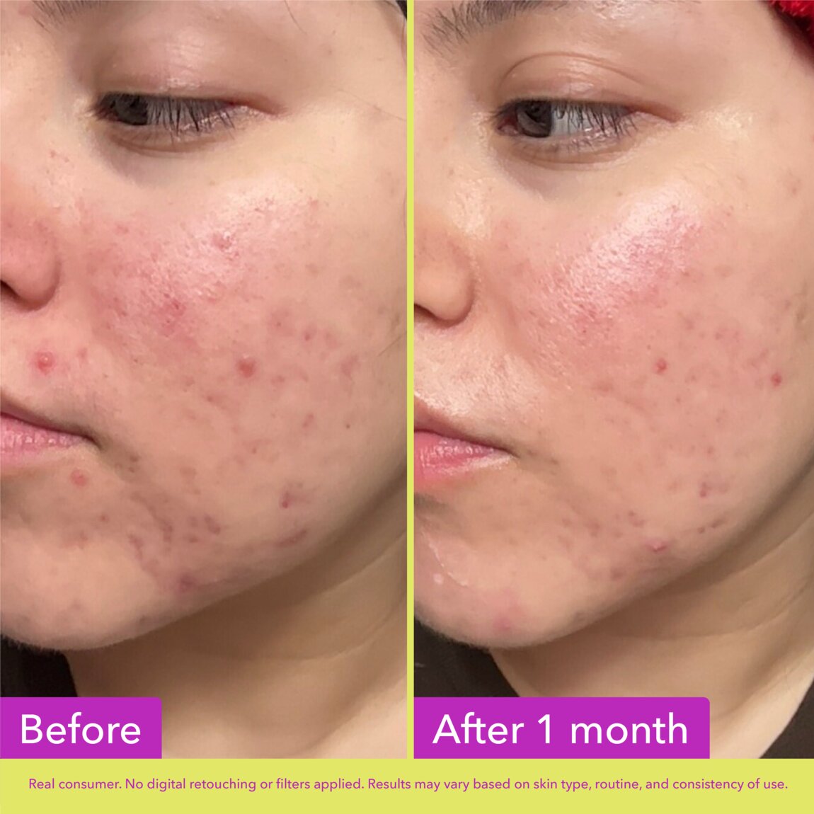 10% Azelaic Acid Treatment I2