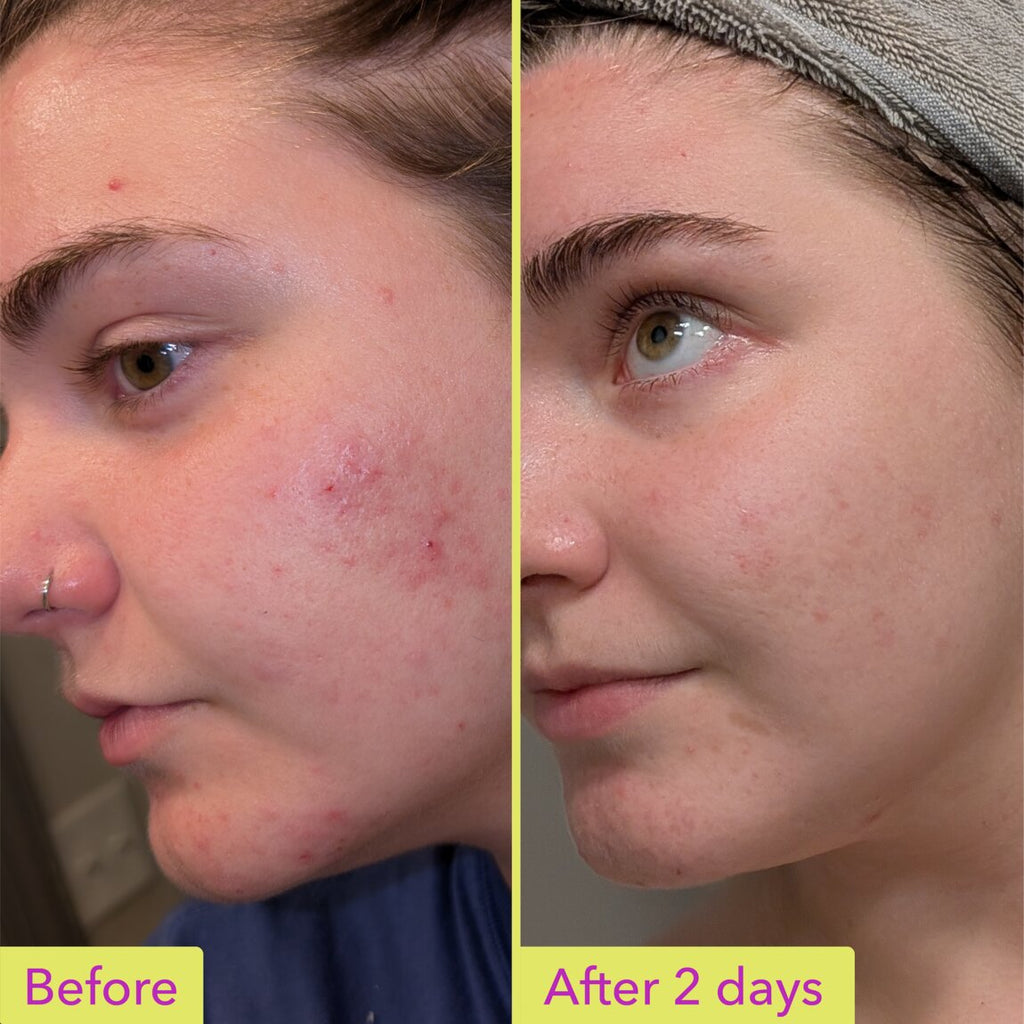10% Azelaic Acid Treatment I2