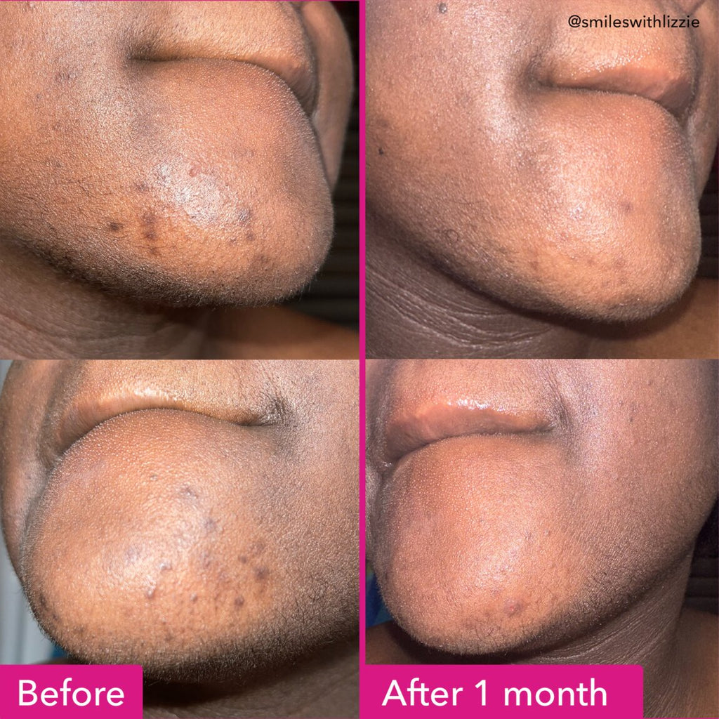Brightening & Dark Spots Bar A2