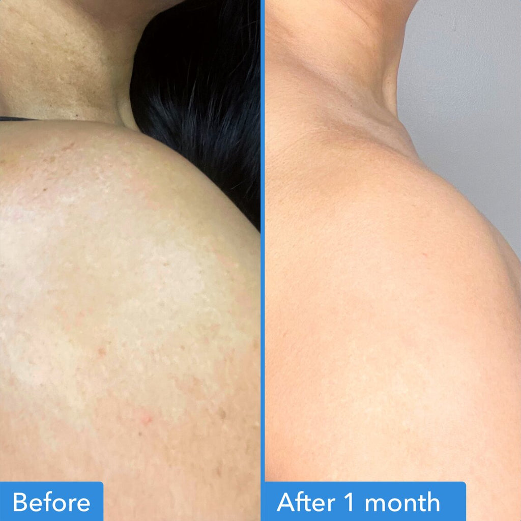 Discoloration Correcting Body Treatment T2