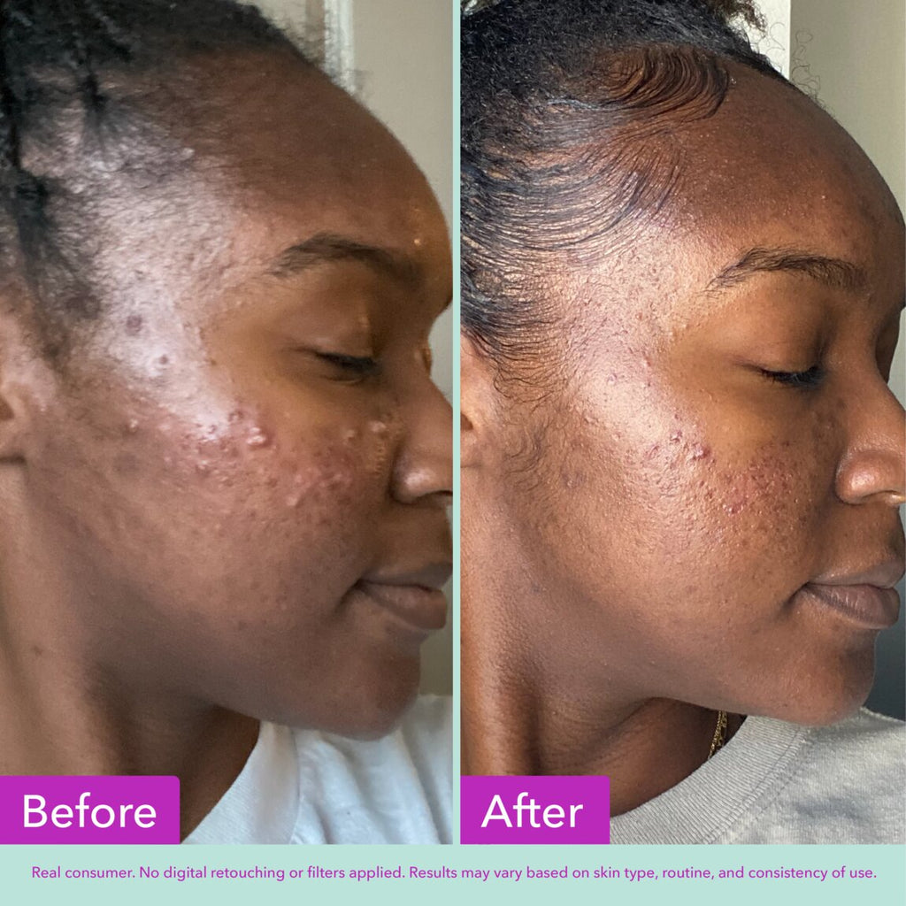 Acne Foaming Cleanser P5