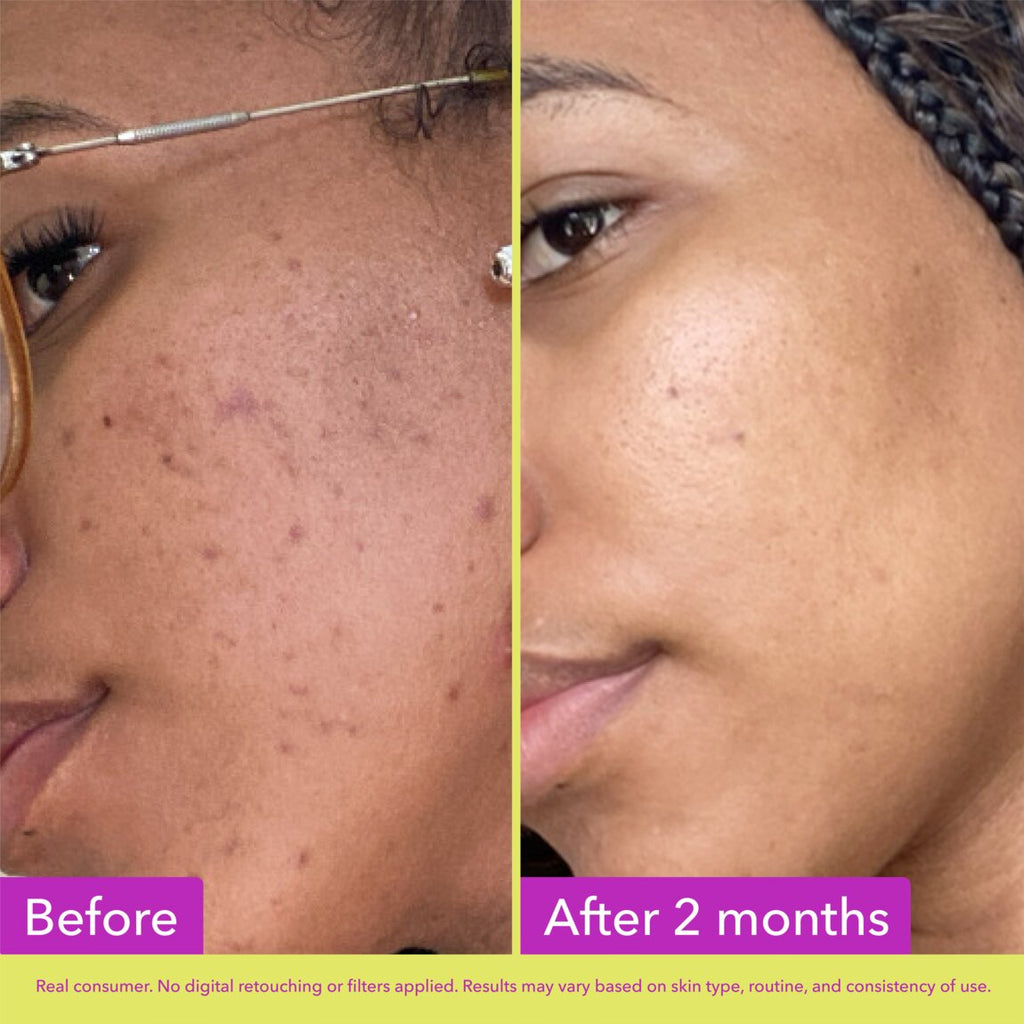 10% Azelaic Acid Treatment I2